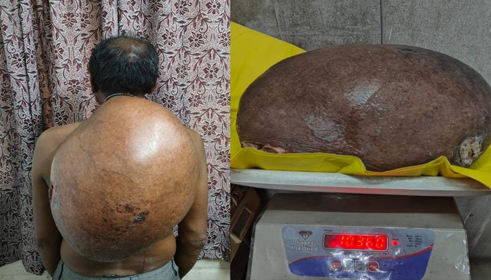 रायपुर में चिकित्सा का कमाल: 10.30 किलो का ट्यूमर निकालकर डॉक्टरों ने रचा इतिहास ट्यूमर निकालकर डॉक्टरों ने रचा इतिहास