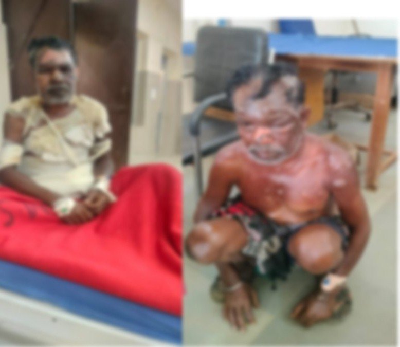 Domestic Violence : छत्तीसगढ़ में खौफनाक वारदात…! शराब बनाने से रोका तो पत्नी ने पति को झुलसा दिया…हालत गंभीर Domestic Violence: Horrific Incident in Chhattisgarh! Wife Sets Husband Ablaze After Being Stopped from Brewing Liquor—Condition Critical.